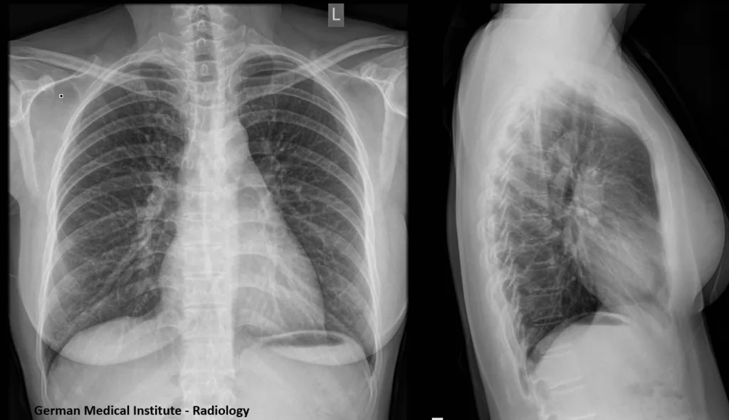 Xray-chest