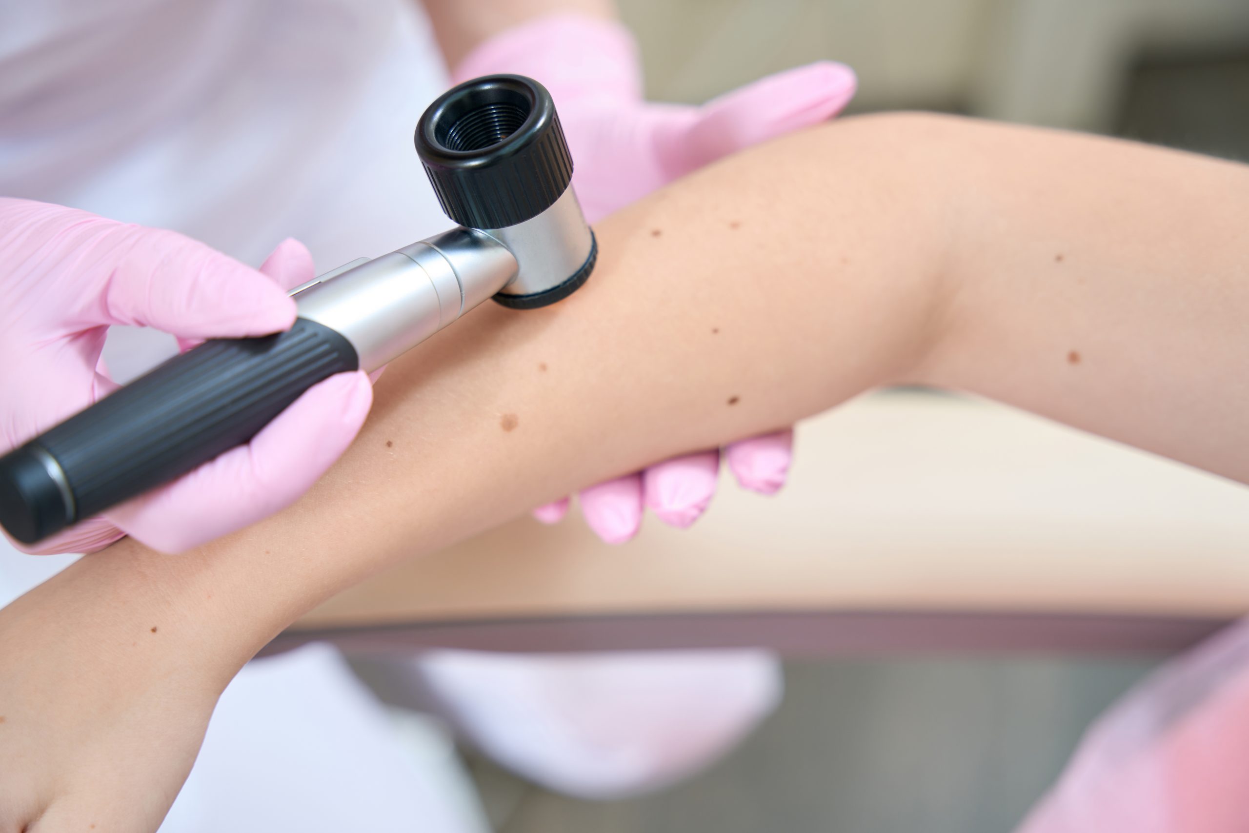 Close-up female hands of a beautician in pink gloves examine the skin on arm of teenager girl with dermatoscope