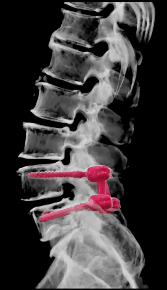ct-lumbar-spine