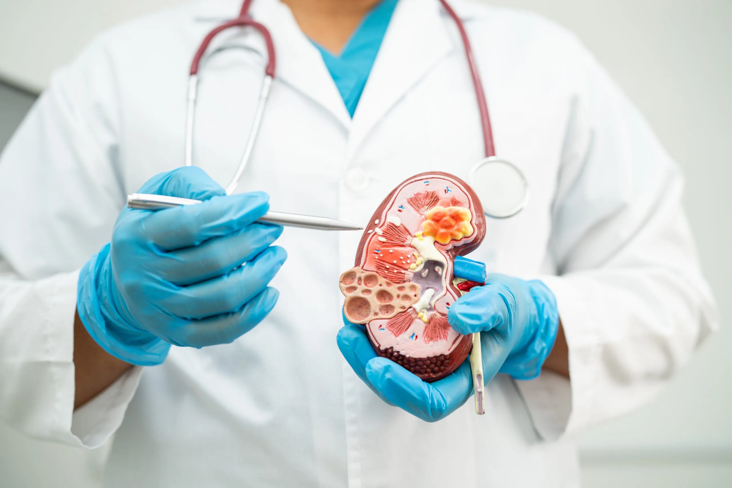 Kidney disease, Chronic kidney disease ckd, Doctor hold model to study and treat in hospital.