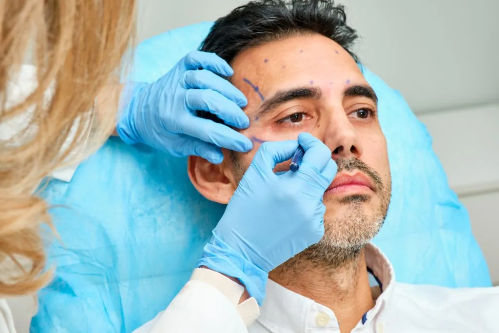 Aesthetic medicine doctor marking the face of a 45-year-old male patient to perform an anti-aging treatment with botulinum toxin