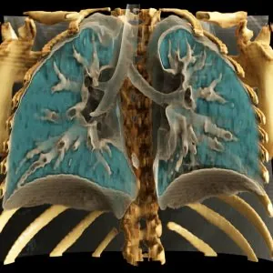 lung-child-low-dose-300x300