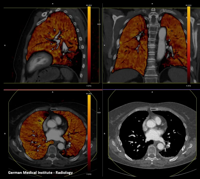 Pulmonary-Embolism-DE1